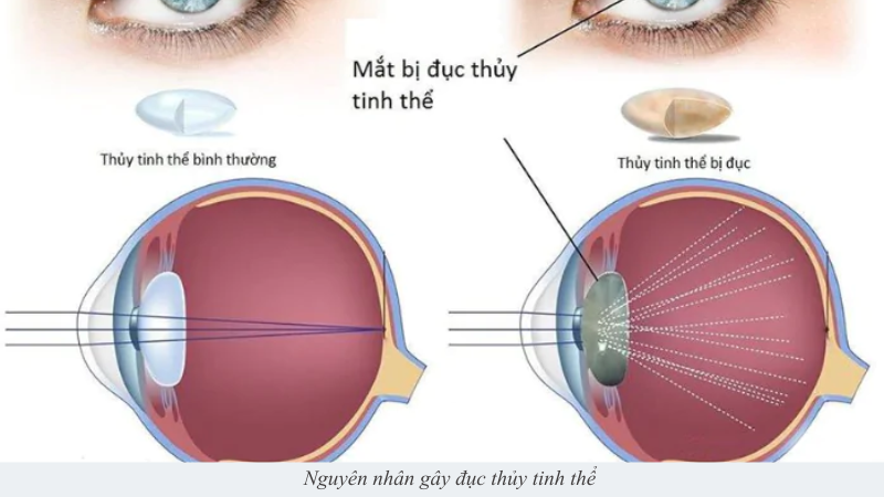 đục thủy tinh thể