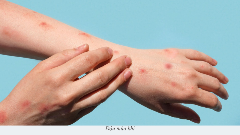 đậu mùa khỉ