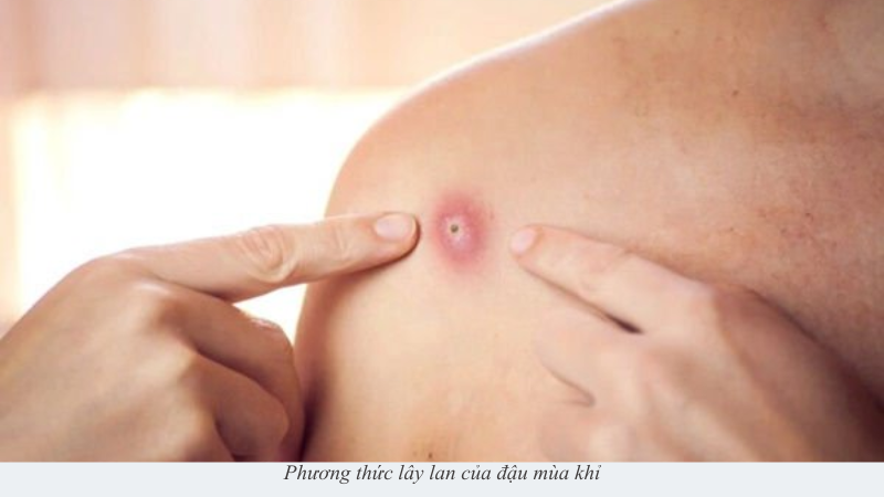 đậu mùa khỉ