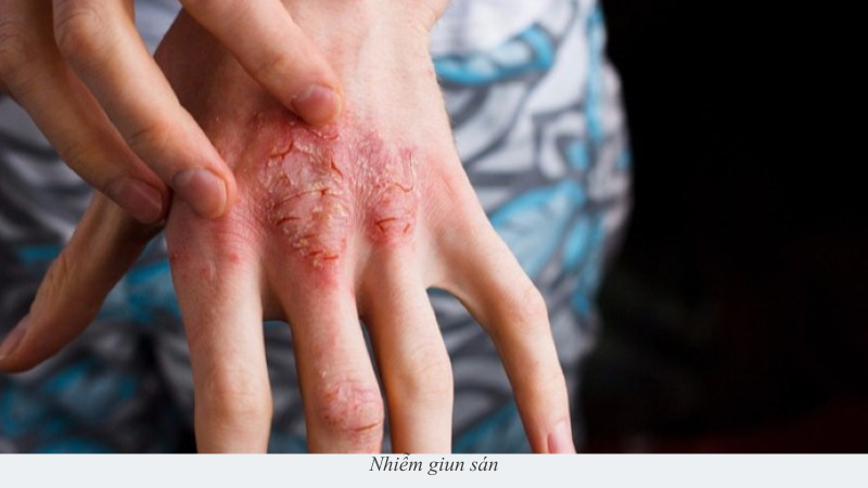 Nhiễm giun sán