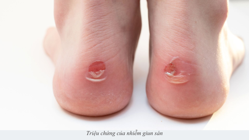 Nhiễm giun sán