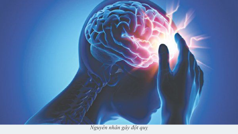 Đột quỵ