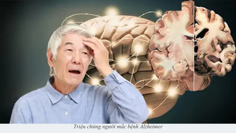 Alzheimer