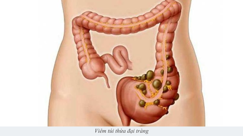Viêm túi thừa đại tràng