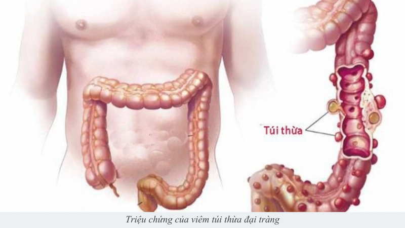 Viêm túi thừa đại tràng
