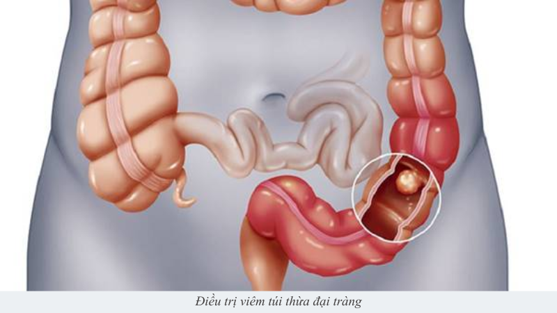 Viêm túi thừa đại tràng