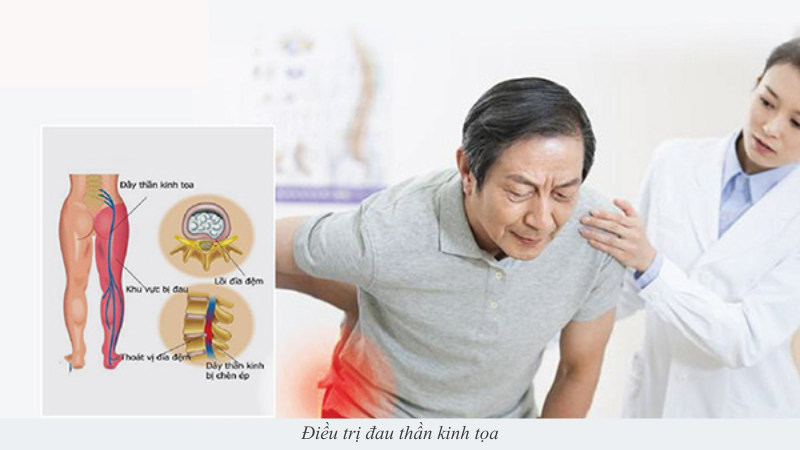 Đau thần kinh tọa